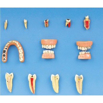 DENTAL DISEASES MODEL